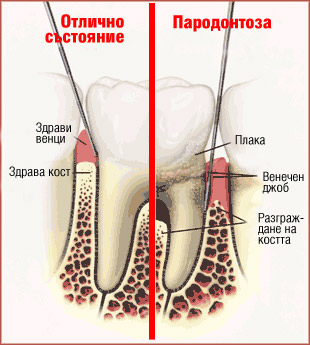 Пародонтология - преди