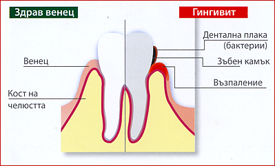Гингивит